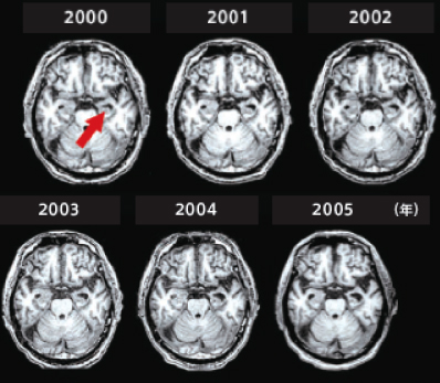 神経認知機能障害の脳内画像